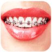 Braces: Real Teeth Braces Pict