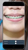 Braces: Real Teeth Braces Pict ภาพหน้าจอ 3