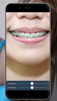 Braces: Real Teeth Braces Pict स्क्रीनशॉट 3