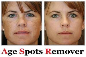 Poster Age Spots Remover  Home Remedy