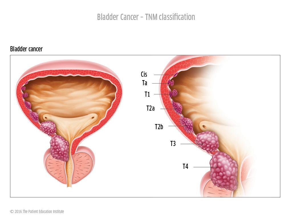 Лечение рака мочевого пузыря у мужчин. Опухоли мочевого пузыря классификация. Классификация опухоли мочевого пузыря TNM. Раковая опухоль мочевого пузыря.