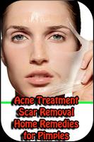 Remedies for Pimples, Acne Tre poster