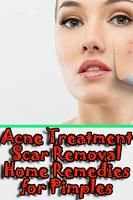 Remedies for Pimples, Acne Tre screenshot 1