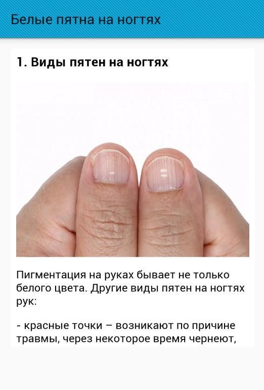 Что означают белые пятна на ногтях рук. Белые пятна на ногтях причины. Белые крапинки на ногтях рук. Белые полосы на ногтях причины.
