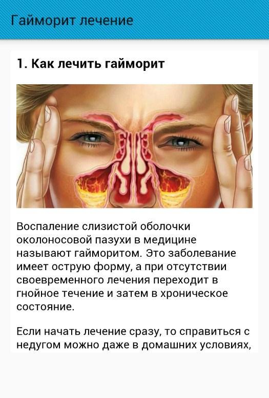 Гайморит домашний. Синусит и гайморит лекарство.