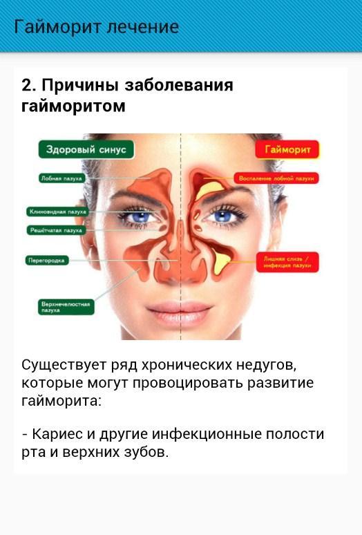 Можно ли гайморите. Начальные симптомы гайморита.