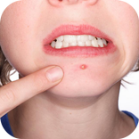 وصفات للتخلص من حب الشباب