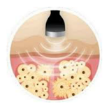 Tratamientos con Ultrasonido