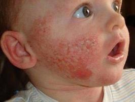 Treat Baby Acne Affiche