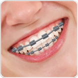 Braces On Teeth Photo Editor