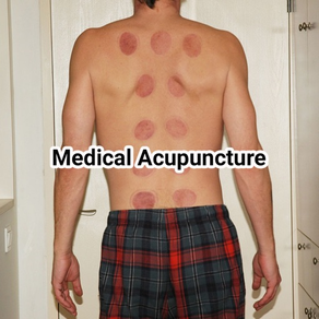 Medical acupuncture