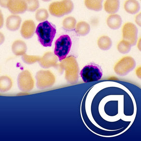 Chronic Lymphocytic Leukemia