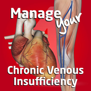Manage your Chronic Venous Insufficiency 4