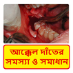 আক্কেল দাঁতের চিকিৎসা ~ Wisdom Teeth Treatment