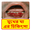 মুখের ভেতর ঘা রোগ এর চিকিৎসা ~ Scurvy disease