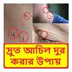 দ্রুত আঁচিল দূর করার উপায়