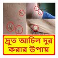 দ্রুত আঁচিল দূর করার উপায়