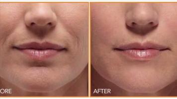 Reduce Wrinkles Naturally - Look Younger Instantly screenshot 2