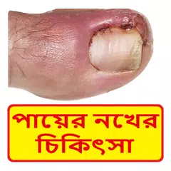 নখের কোনা ওঠা চিকিৎসা ~ Nail Treatment Icon