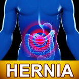 Hernia Diet Help & Food Tips