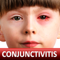”Conjunctivitis & Pinkeye Help