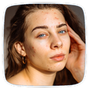Acne Guide APK