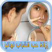 إزالة حب الشباب نهائيا بدون نت