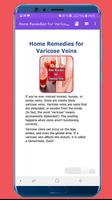 Home Remedies for Varicose Veins capture d'écran 1