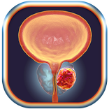 Comment prévenir le cancer de la prostate