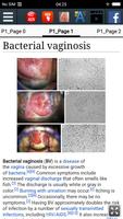 Vaginose bacteriana imagem de tela 1