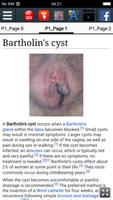 Bartholin's cyst Ekran Görüntüsü 1