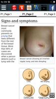 Breast cancer ảnh chụp màn hình 2