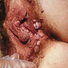 Genital wart : Educational App biểu tượng