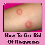 How To Get Rid Of Ringworms