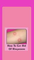 How To Get Rid Of Ringworms постер