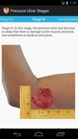 Pressure Ulcer Guide screenshot 1