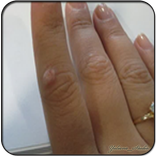 Resep Cara Hilangkan Kutil Dengan Cepat Dan Mudah!