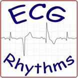 ECG Rhythm