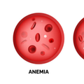 Anemia