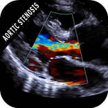 AORTIC STENOSIS PROTOCOL GUIDE