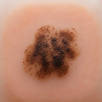 Holey Mole: Skin Tracker APK