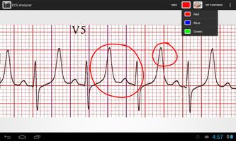 ECG Analyzer capture d'écran 1