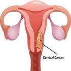 Cervical Cancer アイコン