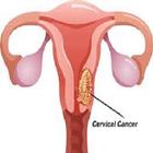 Cervical Cancer icône