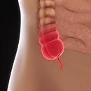 Appendicitis APK