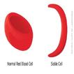 Sickle Cell Anemia