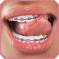 Putting Braces On