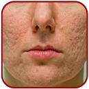 Acne Scar Removal APK