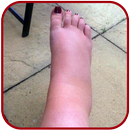 SWOLLEN FEET HOME REMEDIES APK