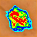 Skin Mole Analysis APK